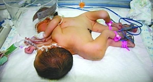 国内年龄最小连体女婴分离手术成功施行