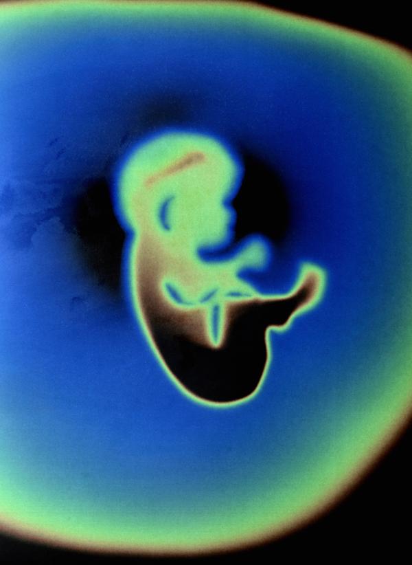 分娩期内胎儿先天性心脏病的胎心检测