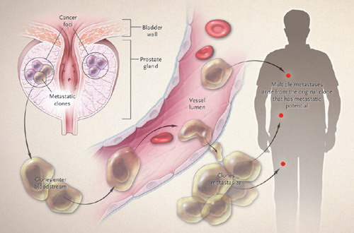 英国研究出副作用小的前列腺癌新疗法