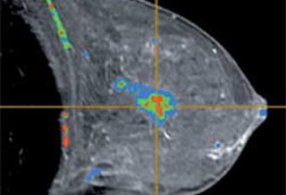 乳腺MRI未能降低再手术率