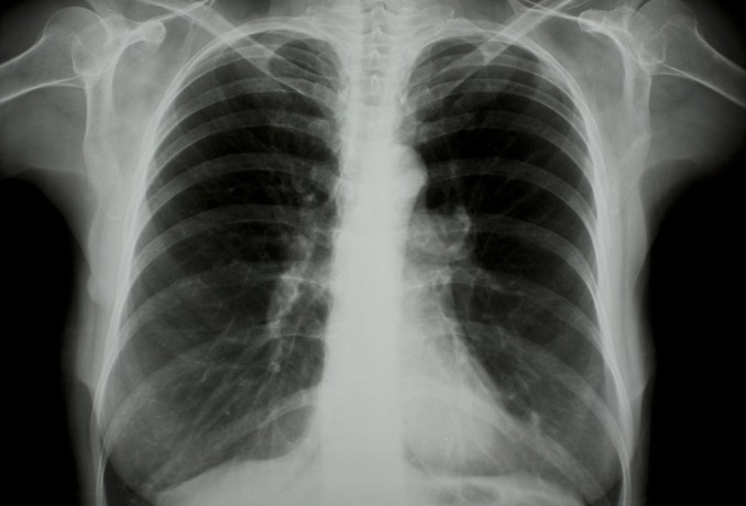 肺癌——第七版外科学