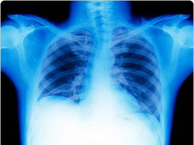 阿奇霉素对成人重度持续性哮喘患者有效（J Am Board Fam Med. 2012 Jul;25(4):442-459.）