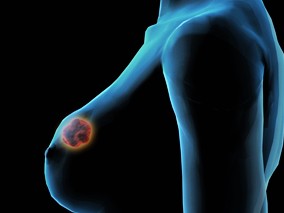 乳腺癌患者快速重建乳房有新法
