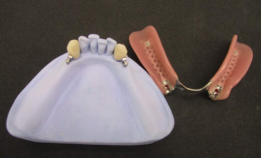 镍钴证实是造成牙科过敏物质