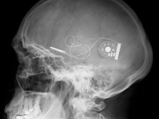 科学家发明置入脑内芯片 可助盲人重见光明