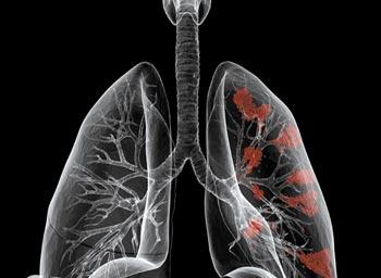 二氧化硅暴露或增个体肺癌风险