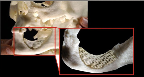 挪威科学家研发支架修复颌骨缺损