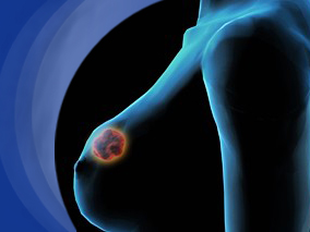 含曲妥珠单抗的新辅助疗法可使局部晚期的乳腺癌患者长期获益