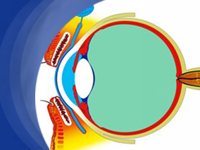 糖皮质激素眼周注射可有效治疗眼葡萄膜炎