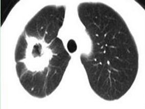瘦弱患者肺部CT血管成像效果：碘克沙醇优于碘美普尔