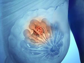 乳腺癌患者：曲妥珠单抗辅助治疗相关的心衰风险评估
