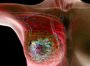 高危早期乳腺癌辅助疗法的最优剂量和时间安排