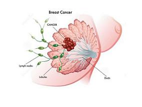 曲妥珠单抗在HER2阳性乳腺癌患者中可诱导心脏毒性