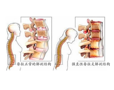 强制性脊柱炎患者椎管内麻醉1例
