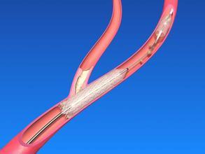 新生儿动脉导管西罗莫司洗脱支架植入的药代动力学