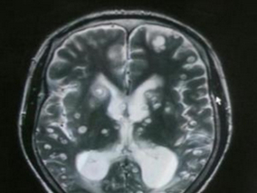 脑囊虫病诊断：钆双胺-MRI脑室造影能提高诊断准确性