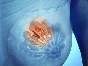 母乳喂养与不同受体状态乳腺癌之间的相关性