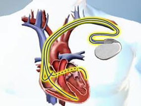 心脏复律除颤器植入前使用指南指导的心衰药物非常必要
