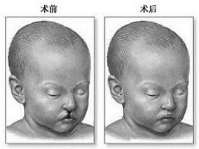 妊娠期使用拉莫三嗪是否增加胎儿唇腭裂风险？