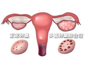 多囊卵巢综合征还是肥胖影响生育能力？