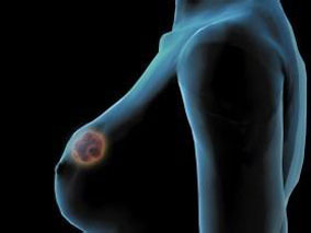 激素受体阳性乳腺癌女性：ASCO辅助内分泌疗法指南更新