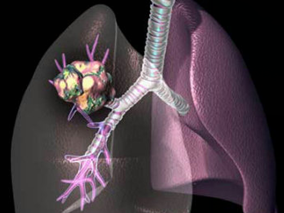 肺癌免疫治疗的思考