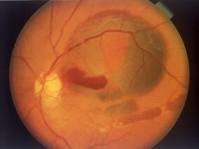 早期持续性视网膜下液的VAMD患者抗VEGF方案的不同应答