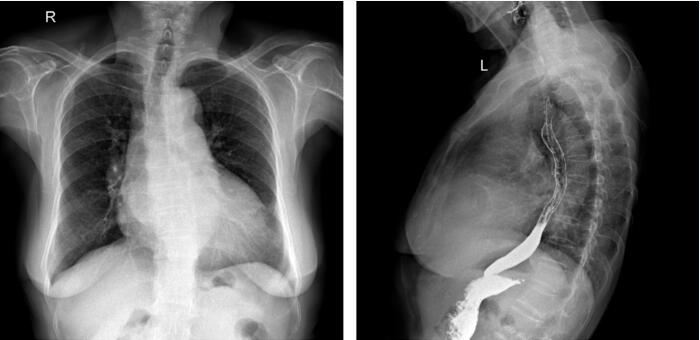 图89-2 入院x线胸片(心脏正侧位)