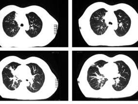 非小细胞肺癌复杂病例：治疗需多思量