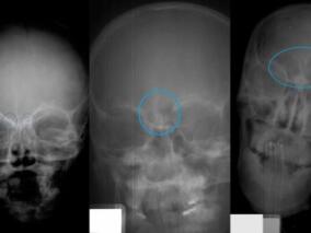 使用X射线可以确定青少年遗骸的年龄
