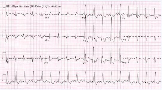 扩张型心肌病常见的心电图改变有哪些?