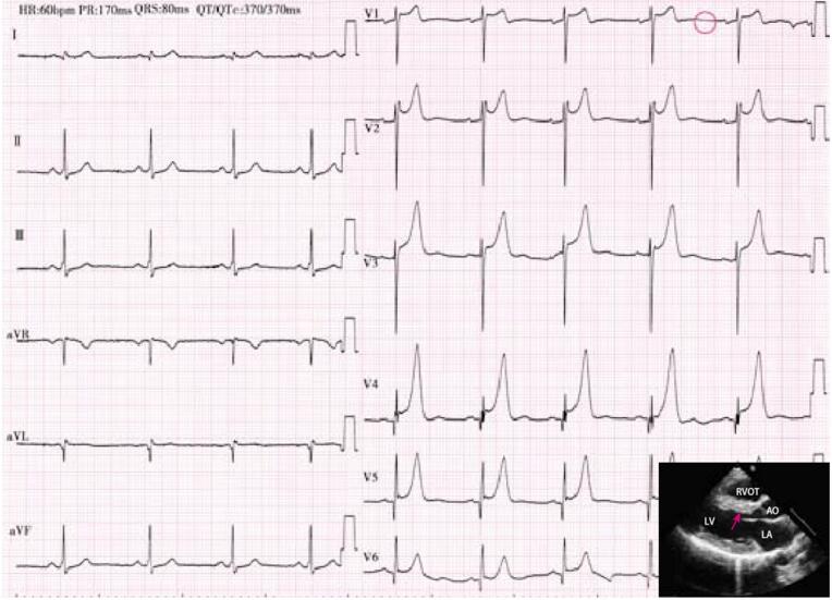 如何从肥厚型心肌病的心电图表现鉴别分型及预测病程进展?