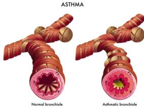 伊马替尼可减少严重哮喘患者的高气道反应性
