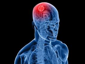 脑脊液IL-10是中枢神经系统淋巴瘤诊断和预后的有效生物标志物