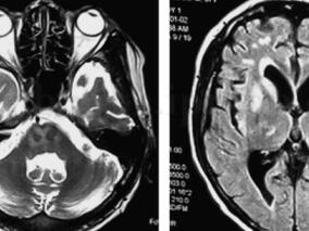 肝移植后脑桥中央髓鞘溶解症3例