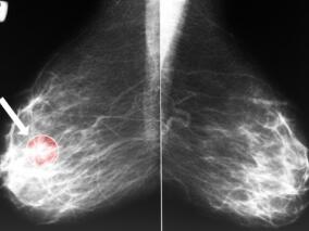 帕妥珠单抗和曲妥珠单抗辅助治疗HER2-阳性早期乳腺癌是否有效？
