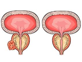 阿比特龙联合强的松能增加转移性去势敏感前列腺癌生存期