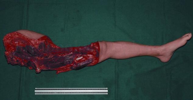 左髂骨软骨肉瘤术后竟两次复发 原来是因为……