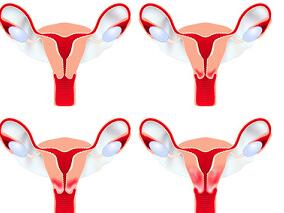 接受孕酮治疗的子宫内膜癌年轻女性的全因死亡率
