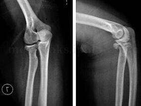 桡骨头骨折：恢复肘关节功能 哪种手术优势尽显？