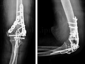 肱骨远端粉碎性骨折 为何不考虑关节置换？