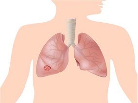 克唑替尼治疗非小细胞肺癌 有这些风险因素的患者应慎用…