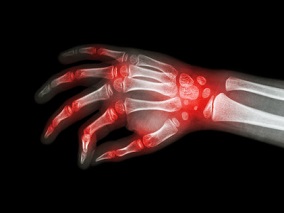 双手小关节肿痛伴白细胞减少 青年女性被类风湿关节炎困扰？