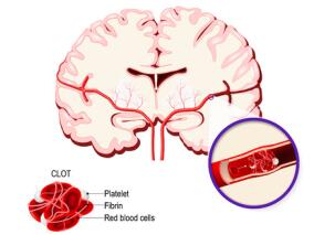 磁共振阳性的经典短暂性脑缺血发作 进展为缺血性卒中1例
