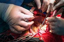 孟旭教授：6种心脏瓣膜病的外科手术时机 看这篇就够了