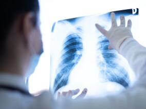 近期加重或既往吸烟史的COPD患者 长期阿奇霉素获益