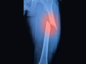 骨质疏松患者的骨折发生率：耐胃酸的利塞膦酸制剂vs其他口服双膦酸盐