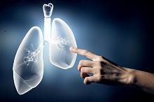 2022 ESMO：Top10肺癌研究一览