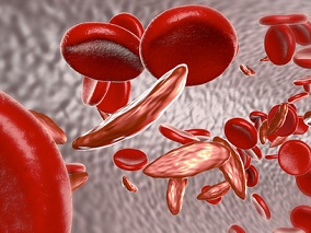 镰状细胞性贫血患儿预防感染 补锌有用吗？