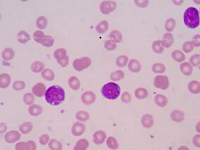 中风险AML：异基因造血干细胞移植vs 标准巩固化疗